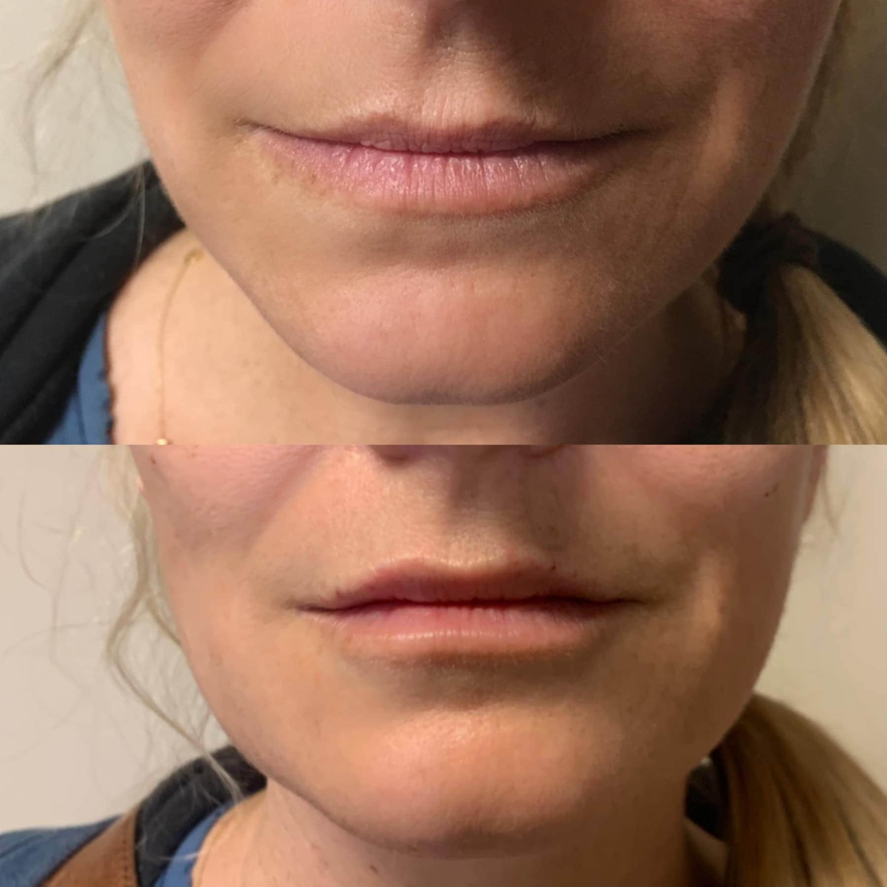 lip before and after