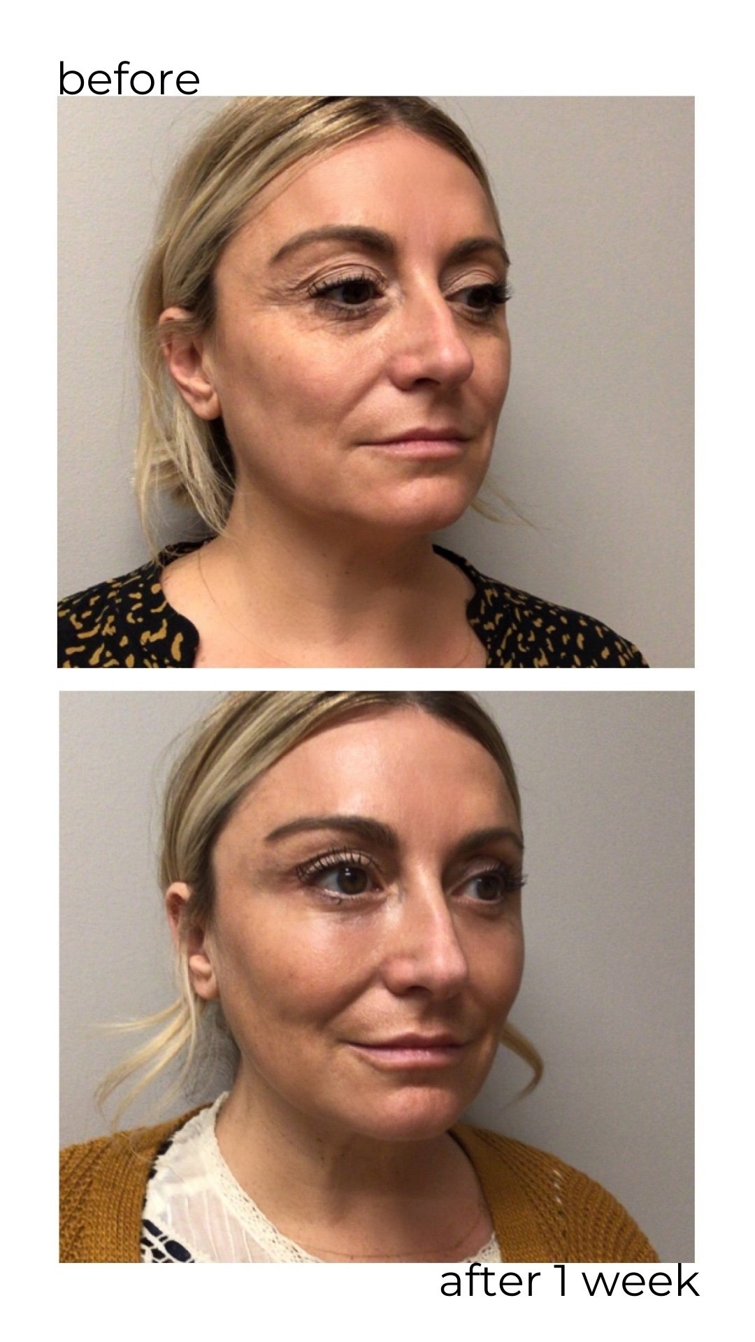 A before and after shot of a woman who has had botox injections and looks very happy.