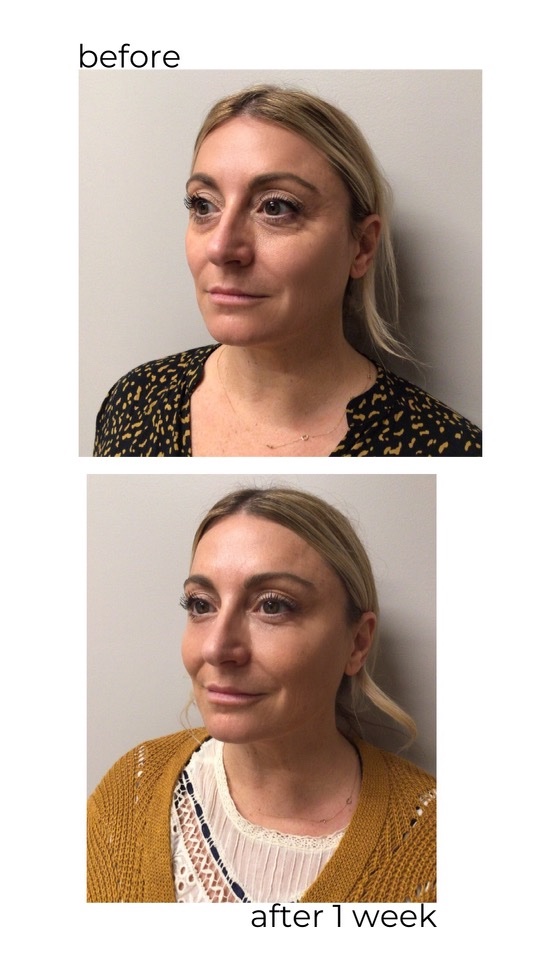 A before and after shot of a blonde woman who has had several medical spa procedures.