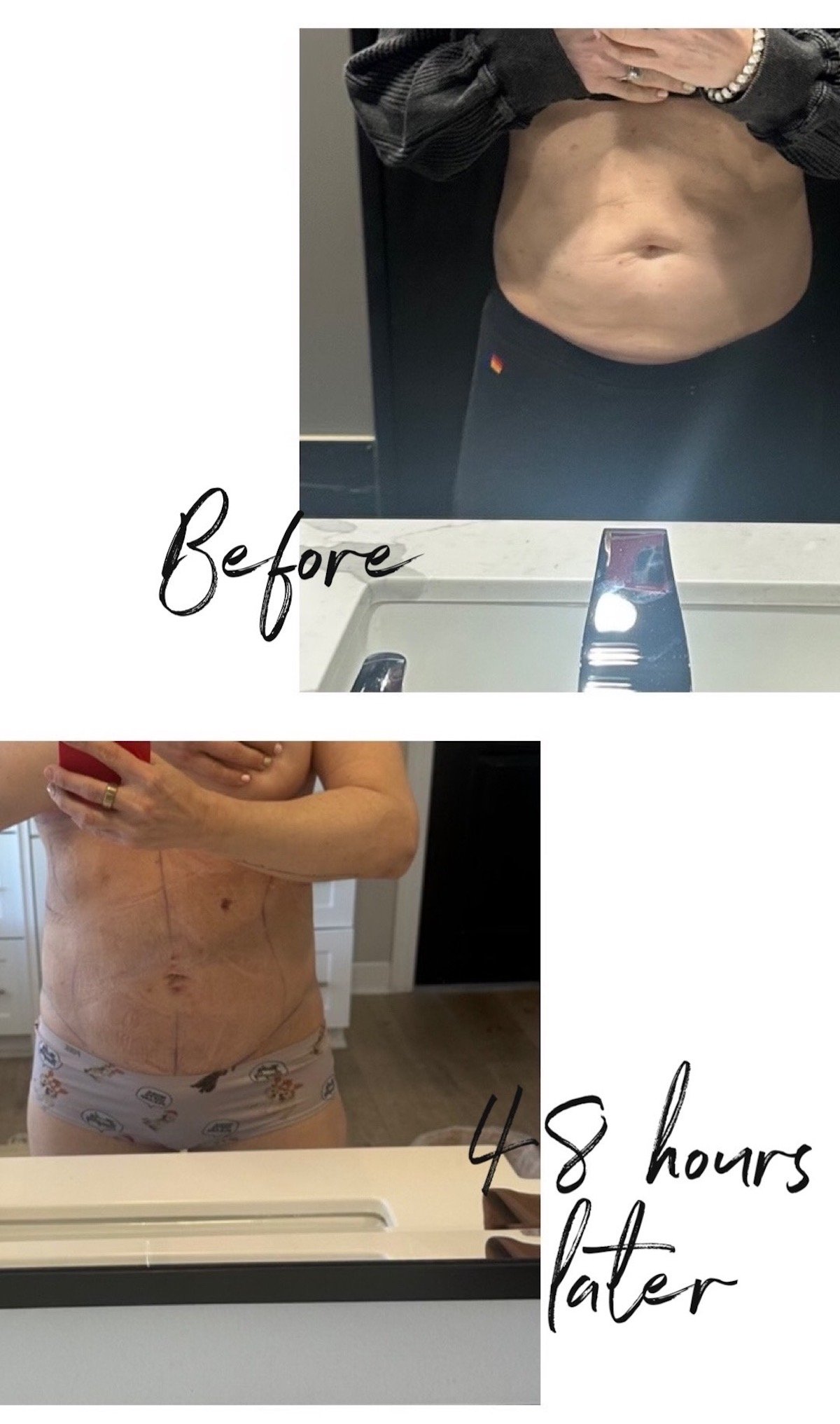 A before and after image of a woman's stomach after the airsculpt procedure.