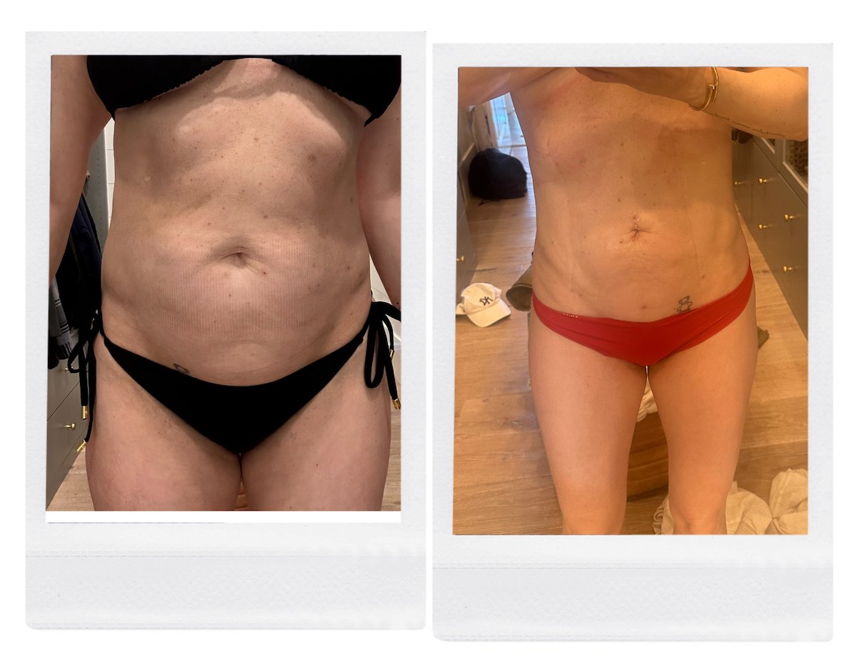 A side-by-side shot of a woman's stomach before and after an airsculpting treatment.