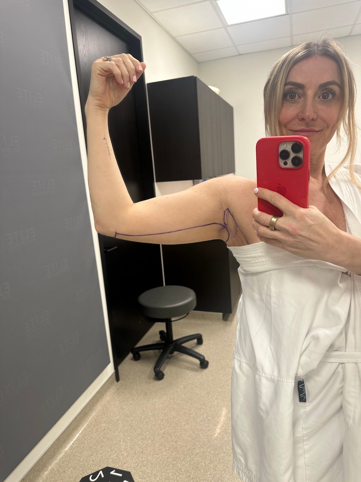 A woman takes a selfie in a mirror showing the lines a doctor made on her arm before her medical procedure. 